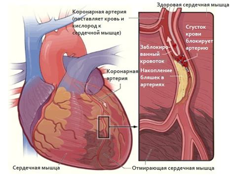 Ишемическая болезнь сердца (ИБС) - симптомы, диагностика, лечение и прогноз