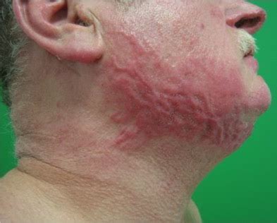 Medical Scar Treatment - Vitamedical