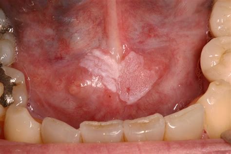 Oral Squamous Cell Carcinoma Floor Of Mouth