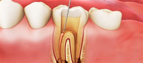 What is dental nerve removal and how it is performed