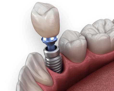 Discover the Benefits of Dental Implants at Hehr Oral Surgery in
