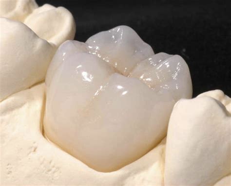 Циркониевая зубная коронка - CRYSTAL - Derby Dental - для передних ...