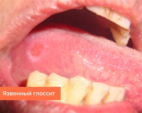 Болит язык сбоку причины чем лечить фото