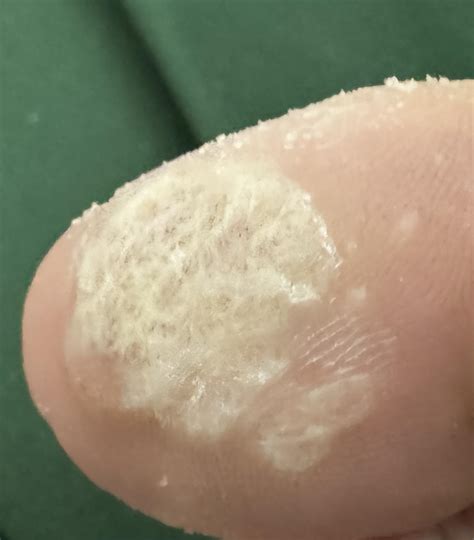Starting my wart removal journey. : r/Warts