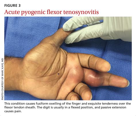 Infectious Flexor Tenosynovitis