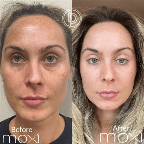 How to Look Younger Without Botox and Fillers | Dallas Derm Partners