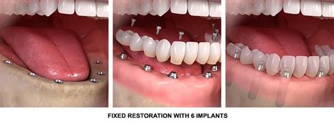 Full Mouth Dental Implants NYC - All-on-6 Dental Implants in New York