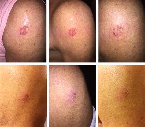 Review - Oncology Post Surgery - Basal Cell Removal - NeoGenesis UK Pro