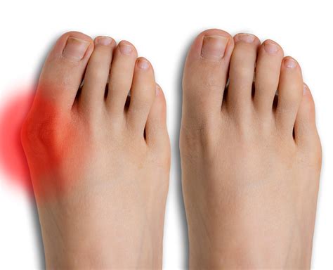 bunion surgery  miami    luxe foot surgery