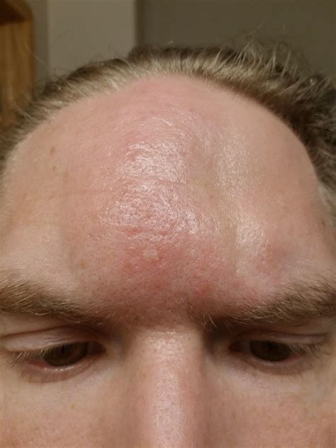 Shingles