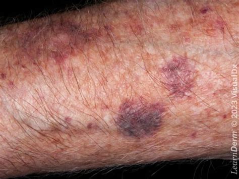 ecchymosis learnderm