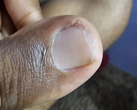 Does this look like the nail may have to be removed? : r/Ingrown_Toenails