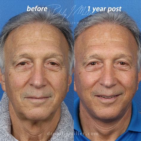 plastic surgery face lift  long  deep plane facelift recovery
