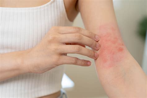 rid   rash  home allergy immunology center