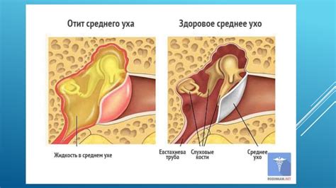 Болезни уха