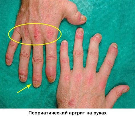 Псориатический артрит: симптомы и лечение, клинические рекомендации