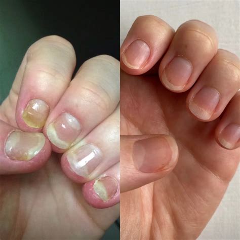 Healing Nail Psoriasis Naturally | Fare and Flora