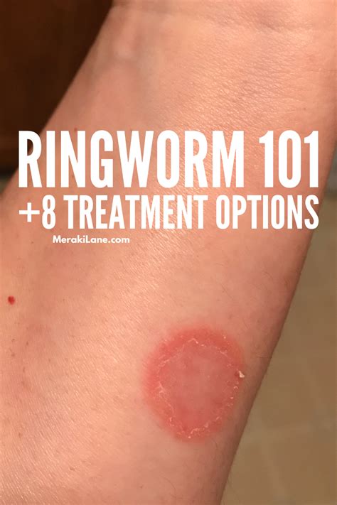 Treatment Ringworm Symptoms