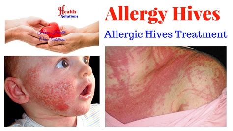 Dr Medico Allergic Reaction Skin Rash Treatment - vrogue.co