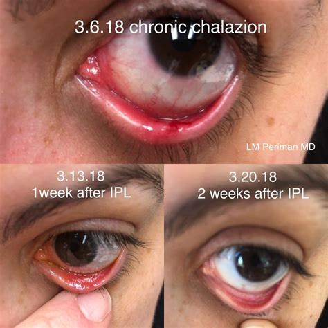 Stye and Chalazion Treatment in Orange