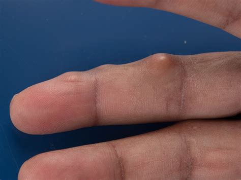 heberden nodules   heberdens nodes rosteoarthritis