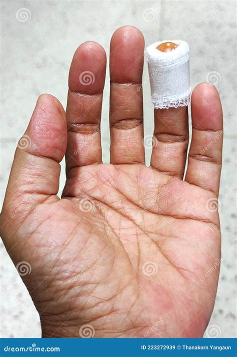 The Knife Cut Off Left Ring Finger, Laceration Wound , Accident at Home. Stock Image - Image of ...