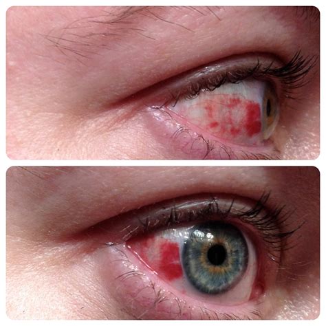 Sudden Red Spot On Eye