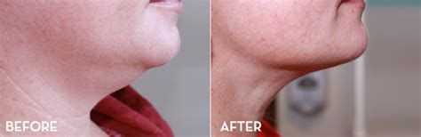 Under Chin Fat Removal Before and After | La Fontaine Aesthetics