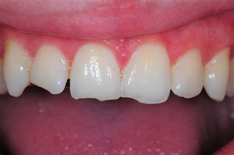 Dental Bonding - Metzger Dentistry