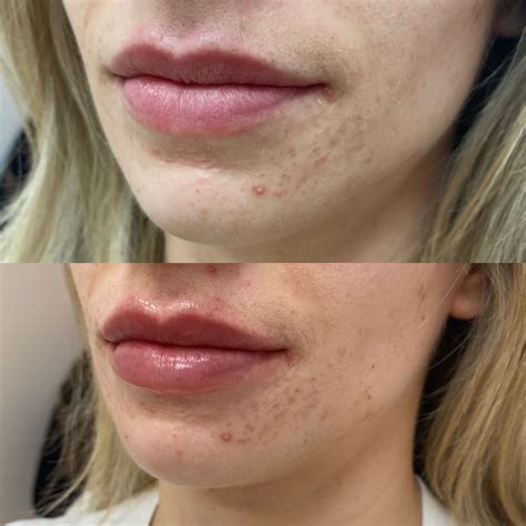 Before & After Treatment Results - Mesa AZ | Emily Frost Aesthetics