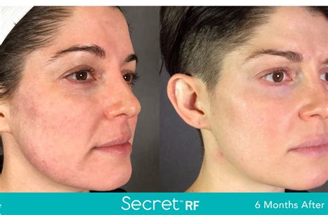 Secret RF Treatment: A Breakthrough in Anti-Aging | Prescott Medical ...