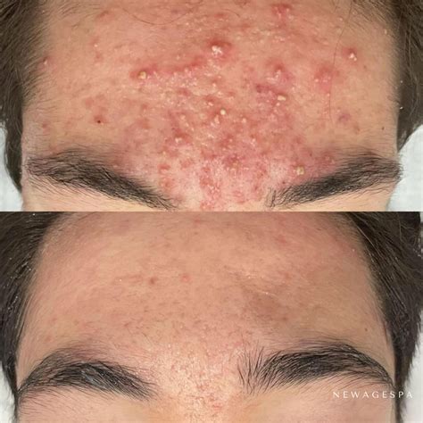 Blackheads and Whiteheads Treatment - NEW AGE SPA