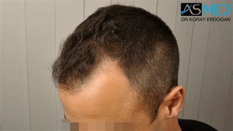 2400 Grafts Fue | Norwood 2 | Asmed Hair Transplant Results