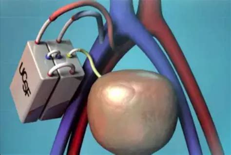 Is Artificial Kidney Transplant Possible in India? | by Denesa Health ...