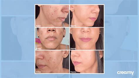 Ácido Mandélico Creamy Antes E Depois - Cryslaine Macieira: "Creamy é mais que uma pele bonita”