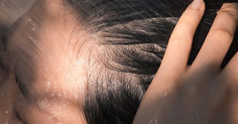 Do Lice Like Clean Hair? Busting the Myth