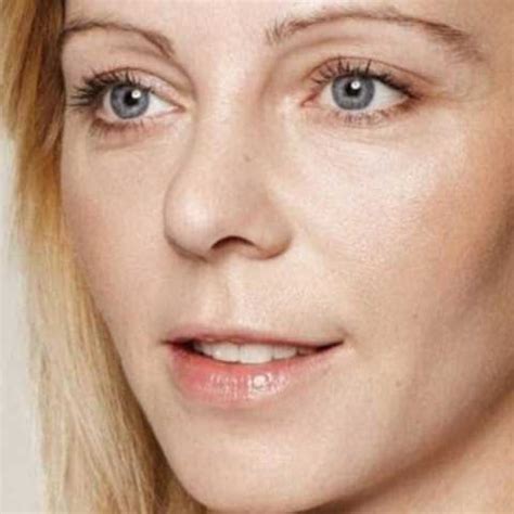 face lifting treatment hermosa medspa facial body treatments