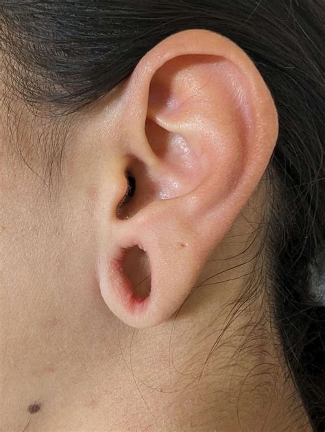 Gauged Earlobe Repair At One Month Post-op. | Solent Vascular Care