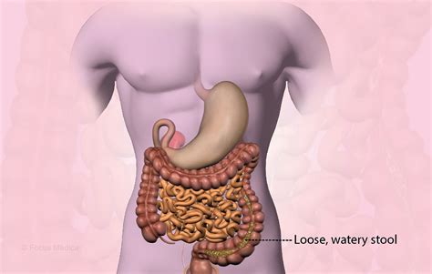 diarrhea types  symptoms diagnosis  treatment