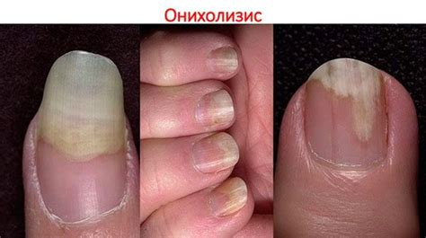Отслоение ногтевой пластины на руках. Лечение, капли, народные средства ...