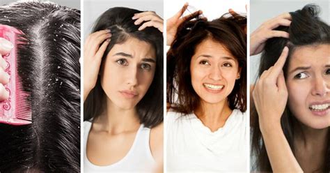 Best 15 DIY To Get Rid Of Dandruff : Some Effective Remedies