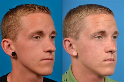 Patient 122406372 | Male Rhinoplasty Before & After Photos | Clevens ...