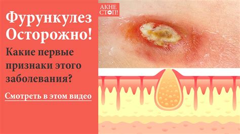 ОСТОРОЖНО Фурункулез! УЗНАЙ Какие первые признаки этого заболевания ...