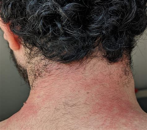 concerns about lymphoma related skin rashes. : lymphoma