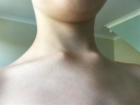 Lump On Neck Near Collar Bone