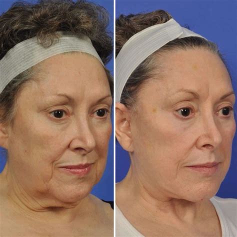 face lift  vietnam  affordable  effective options