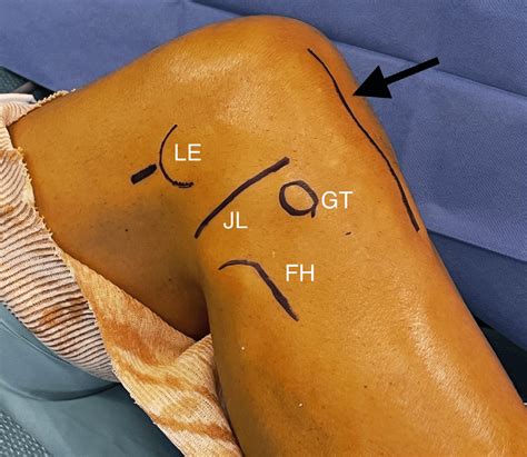 patient positioning  landmarks lateral view   knee