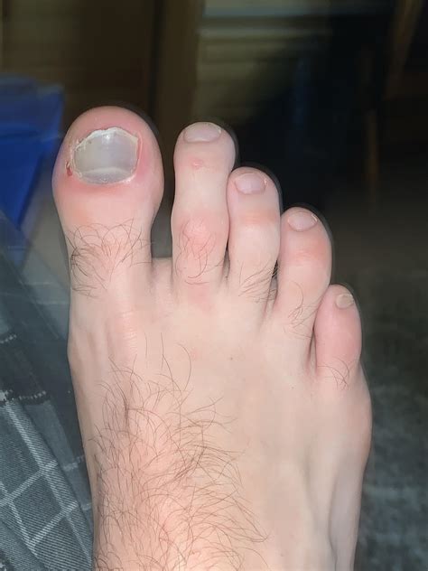 Bruise under my nail. Do I need to go to a doc for this? : r/DoctorsAdvice