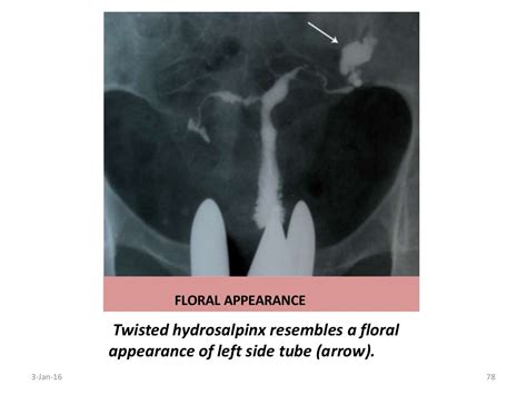 Hysterosalpingography