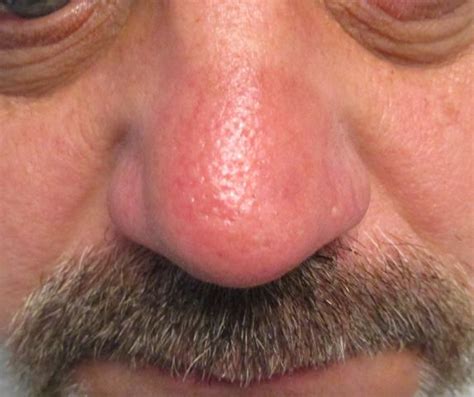 MOHS Surgery Photos | Before & After | ADC Derm